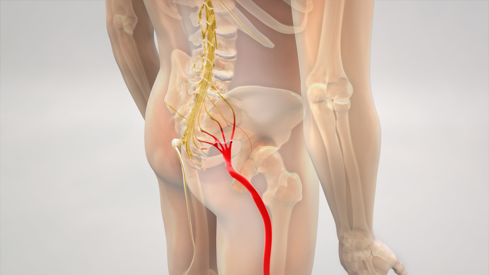 Treating Sciatica Pain at Home and in the RA Office