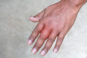 How Long Does a Swollen Finger Last
